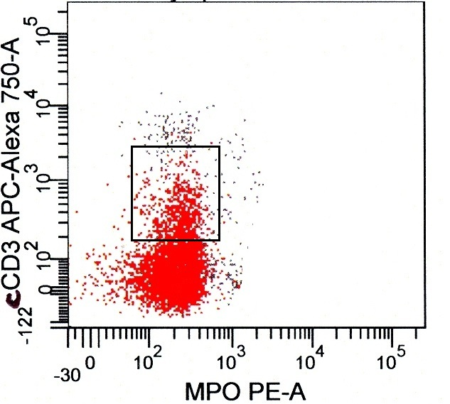 Figure 7c: Flow cytometry (cont.). Two blast population subsets with differing HLA-DR and CD99 expression. Very dim cCD3 and TdT positive subsets are seen. Blasts are negative for MPO.